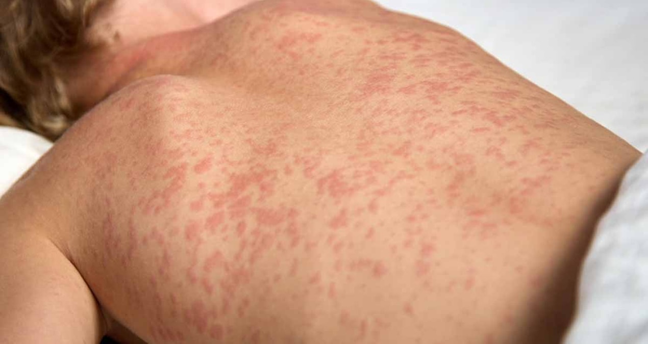 kizamiga yakalandiktan 10 yil sonra hayatini kaybetti nedeni tum ailelere ornek oldu 2rxtAdl3