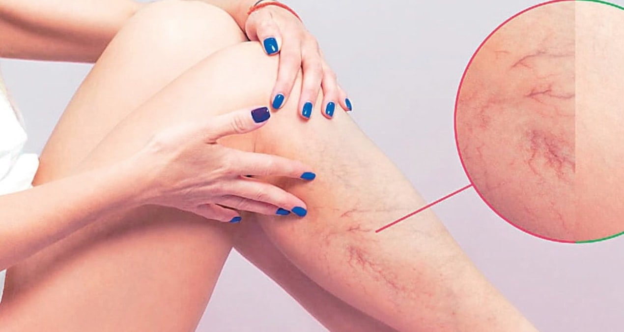 varis vucutta pihti riskini artirabilir xdeELs6a.jpg